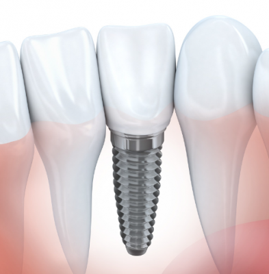 牙種植體dental implants