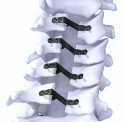 自穩(wěn)定型頸椎椎間融合固定系統(tǒng)endoskeleton tcs interbody system