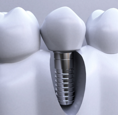 牙科種植體系統(tǒng)dental implant system