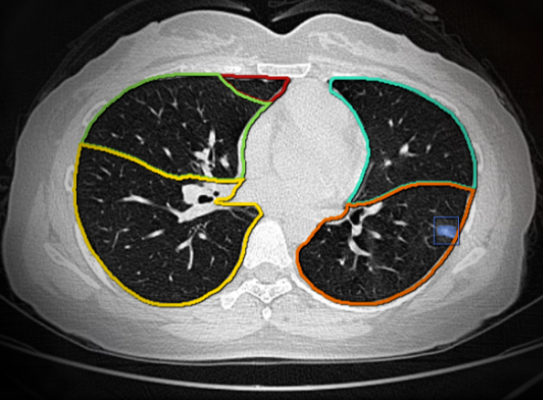 肺結(jié)節(jié)ct圖像輔助檢測(cè)軟件sensecare-lung